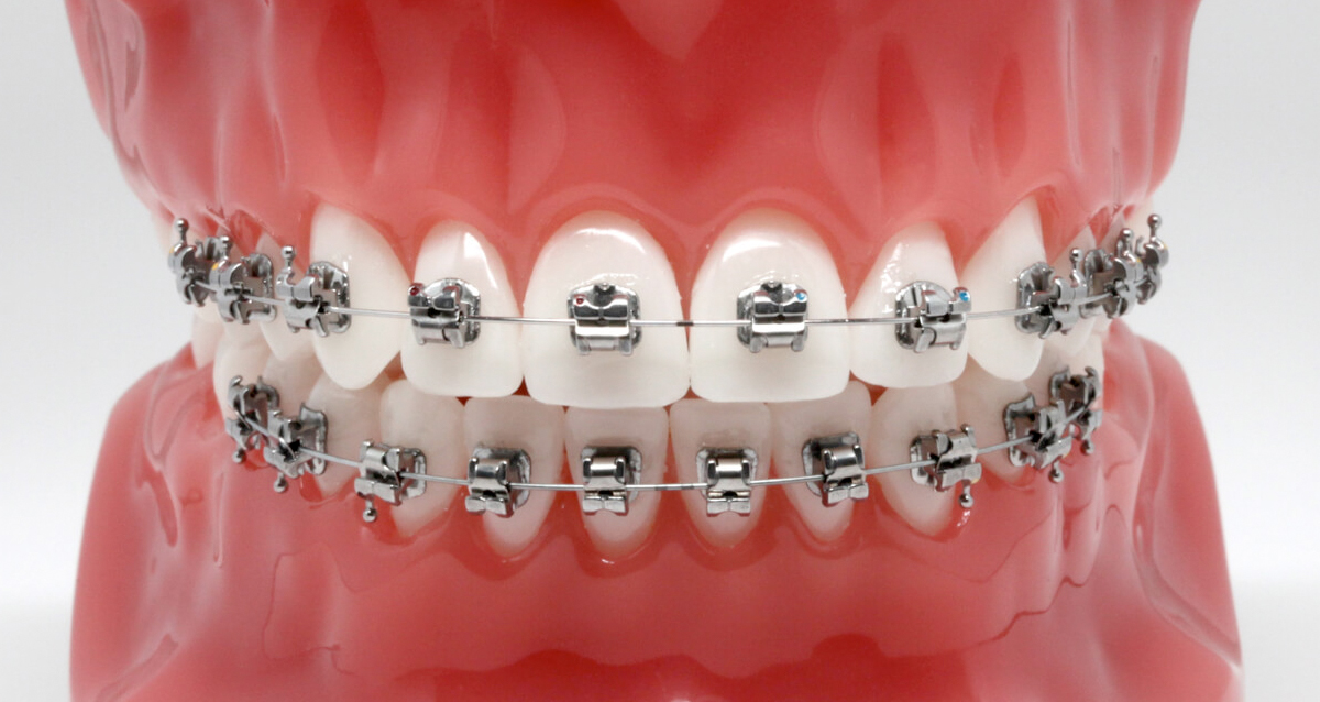 Все в ряд: выбираем брекеты